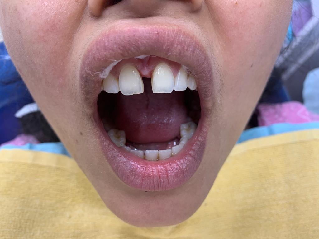 Aesthetic Space Closure before treatment